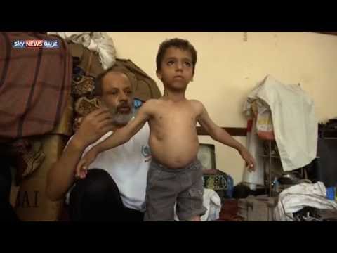 فيديو عائلة يمنية بين سياط التشرد وسطوة المرض