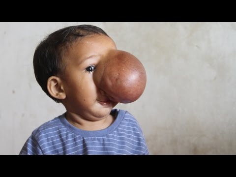 بالفيديو مواقع التواصل تنقذ طفلة من ورم ضخم غطى نصف وجهها