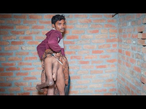 شاب هندي يعاني من ذيل مكون من ساقين إضافيتين