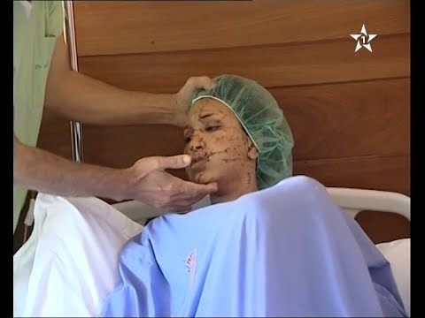 بالفيديو زوج يشوه وجه زوجته القاصر بشفرة حلاقة