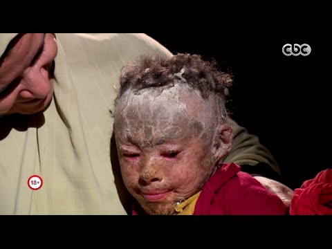 بالفيديو  طفلة مصرية تتعرضث للإصابة بأغرب مرض نادر