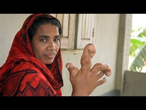 بالفيديو حالة نادرة لامرأة لديها يد عملاقة